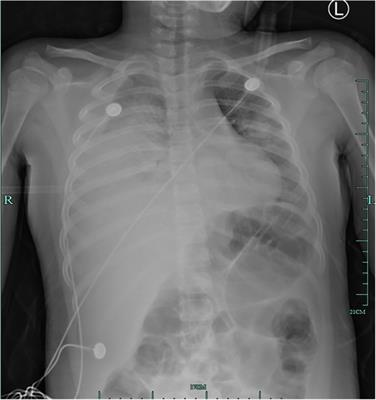 Severe pediatric Mycoplasma pneumonia as the cause of diffuse alveolar hemorrhage requiring veno-venous extracorporeal membrane oxygenation: A case report